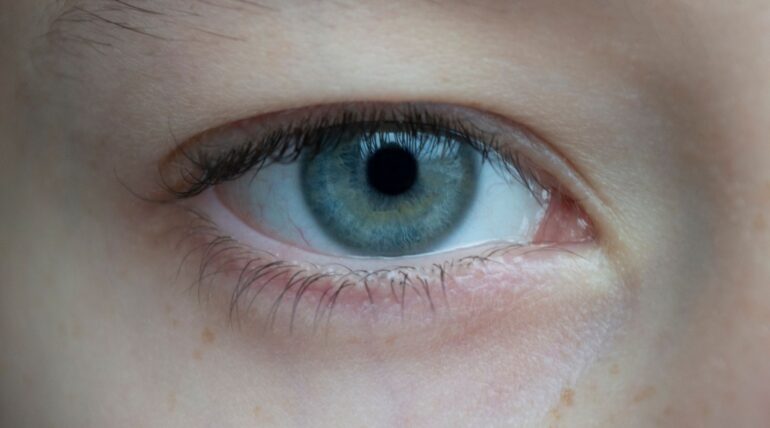 rischio distacco retina dopo cataratta