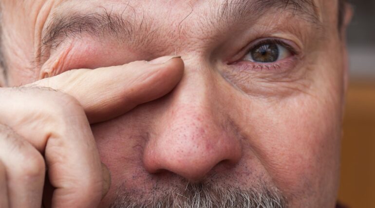 Cos'è la maculopatia e quali sono i tipi più comuni